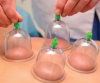 Integrated Dry Cupping Therapy